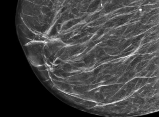 dijital-mamografi-sens-ROI